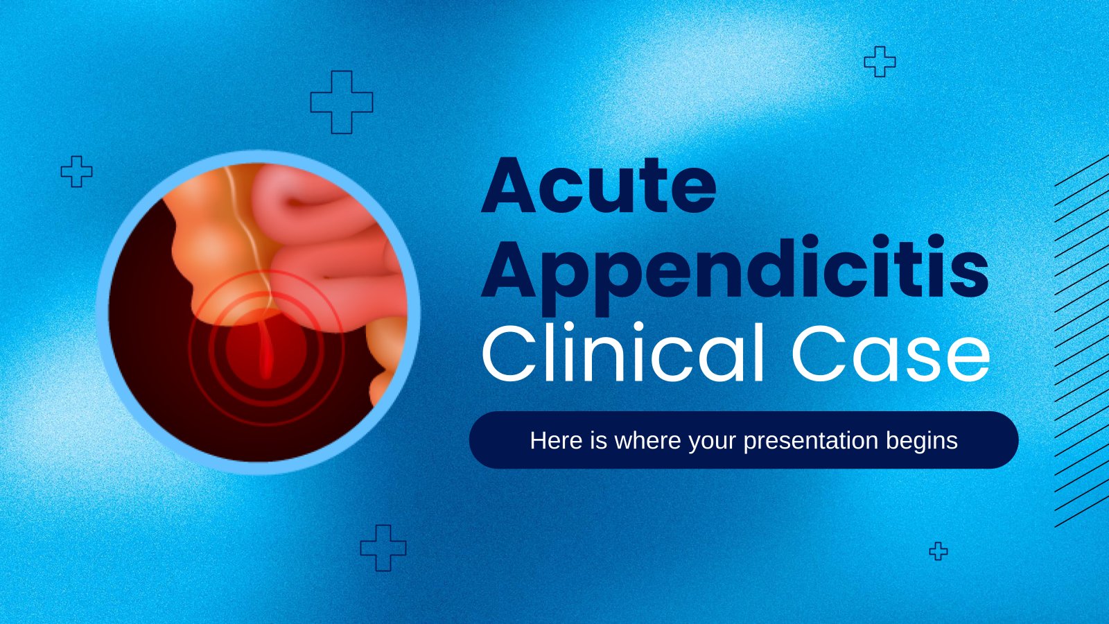 Acute Appendicitis Clinical Case presentation template 