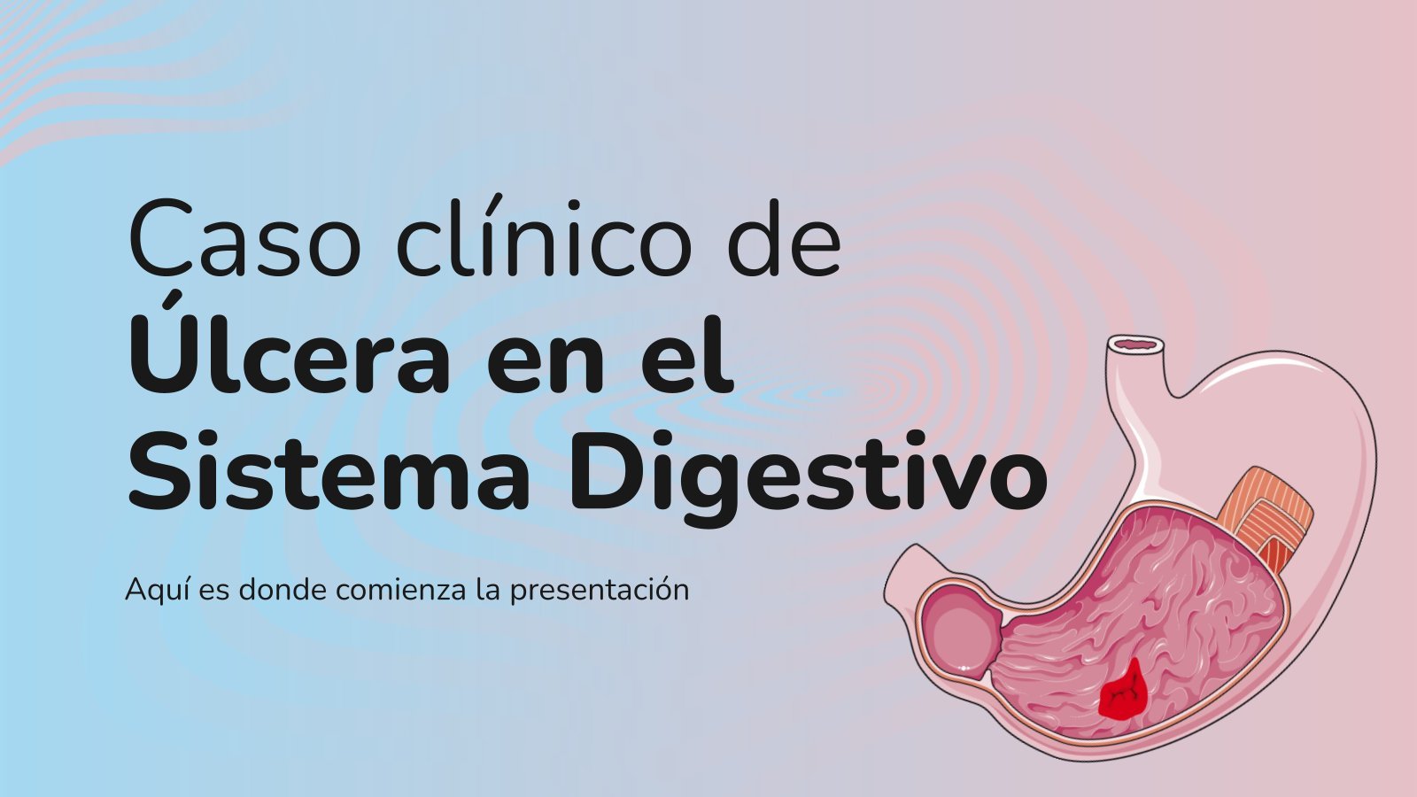 Plantilla de presentación Caso clínico de Úlcera en el Sistema Digestivo