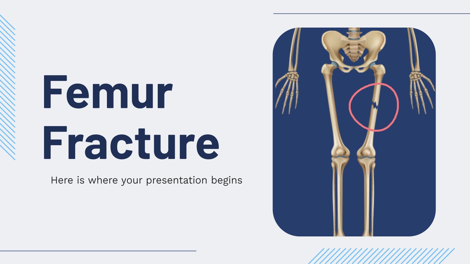 Fracture du fémur Modèles de présentation